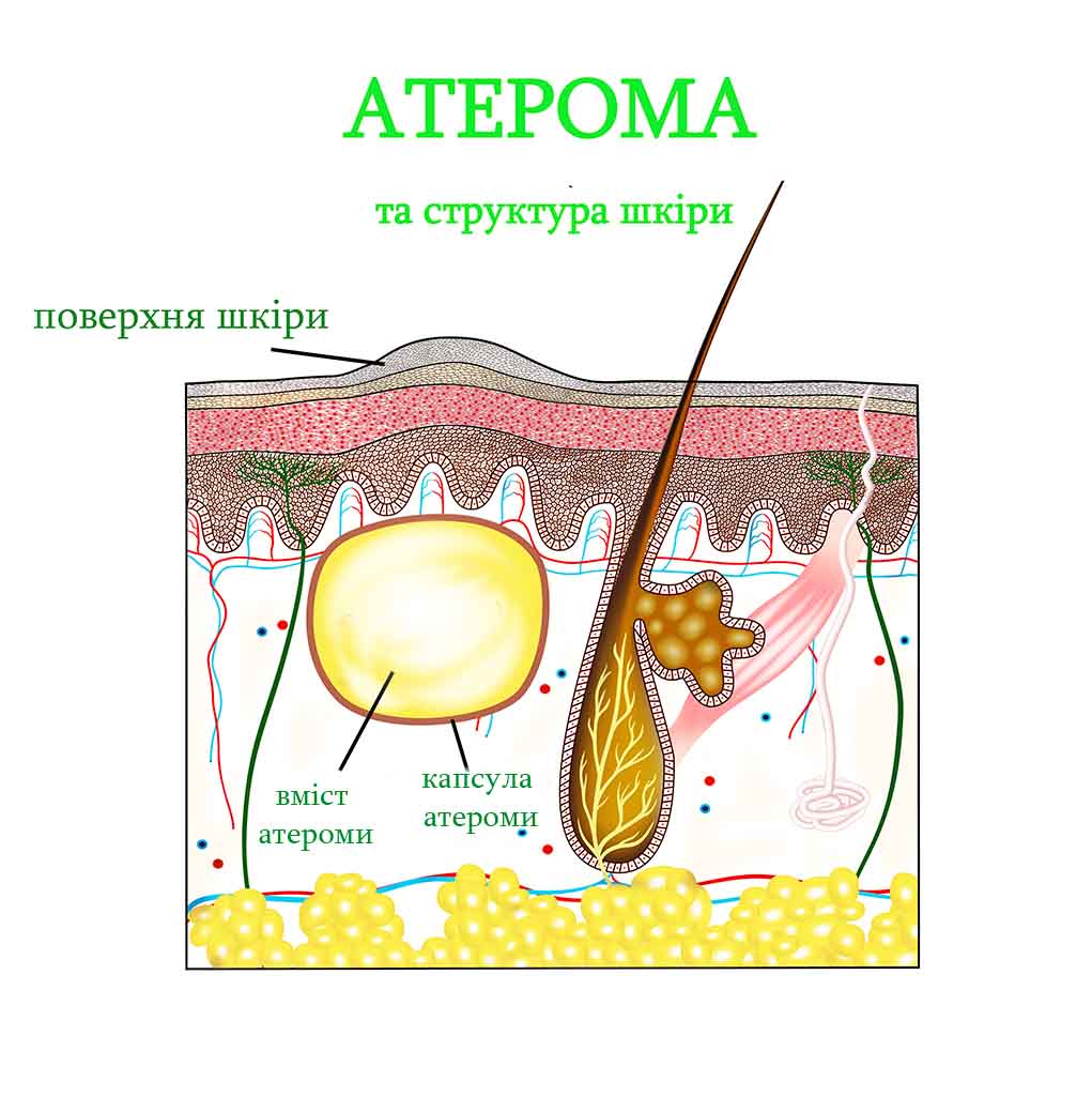 атерома та структура шкіри